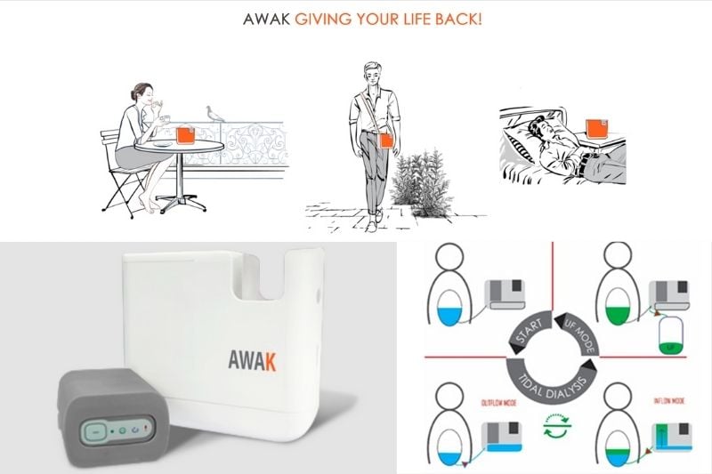 Image to show a portable dialysis process when using AWAK's prodcuts